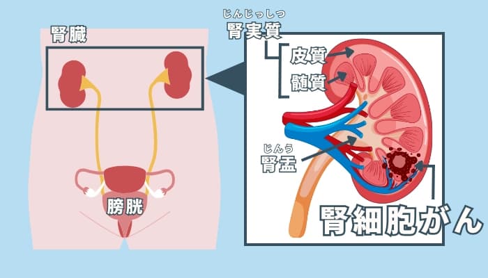 腎臓がんのインフォグラフィックス