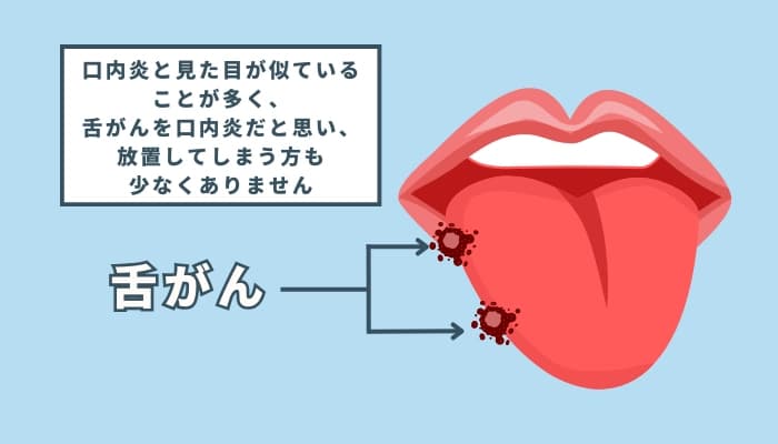水素吸入と舌がん『舌がんってどんな病気?』