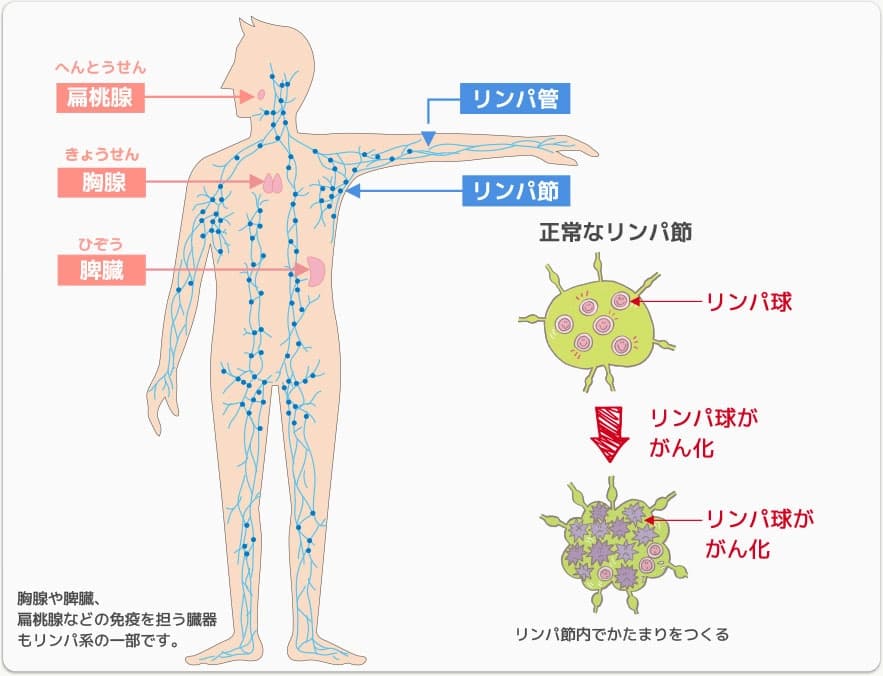 悪性リンパ腫について