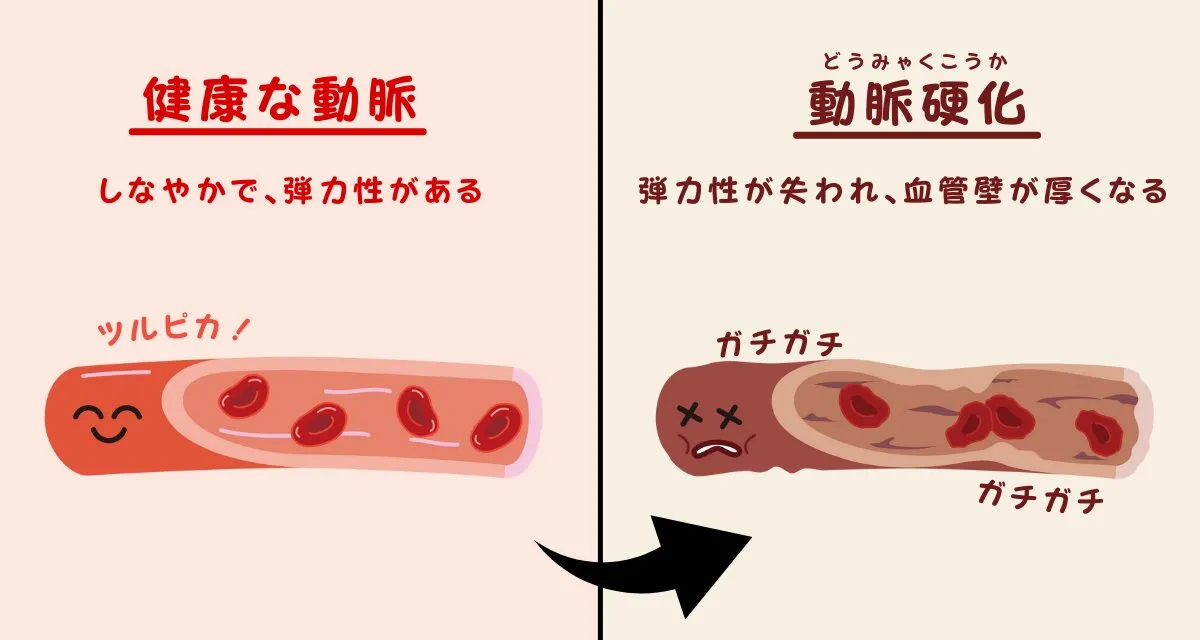 動脈硬化とは