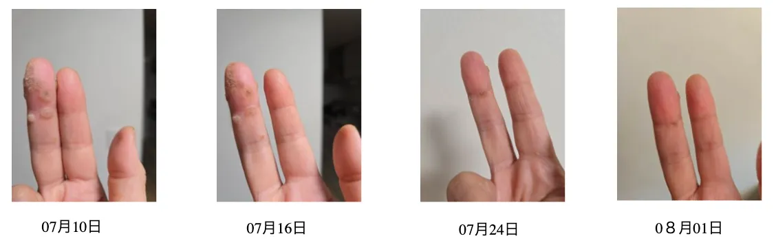 乳がんで闘病中の方の水素吸入体験談(火傷の痕が改善している)