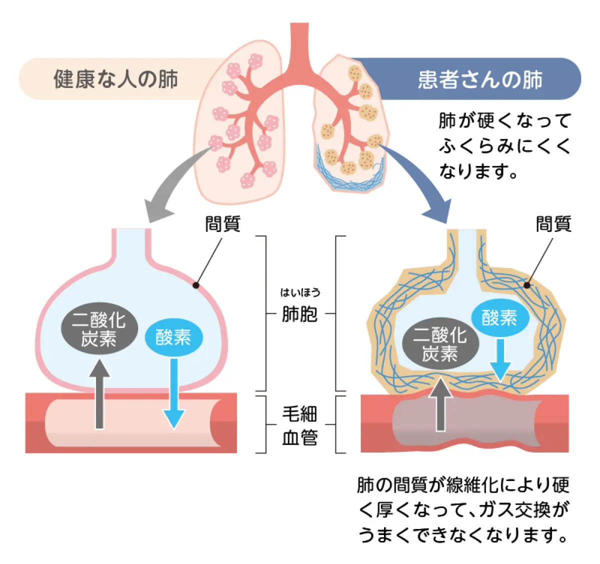 肺線維症とは