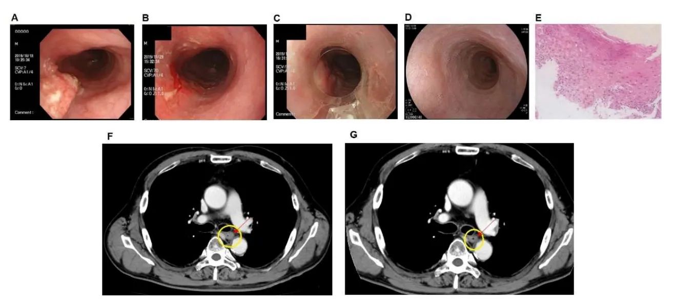 食道がんの治療前後の内視鏡画像(Yorozu et al., 2022, Fig.2より引用)