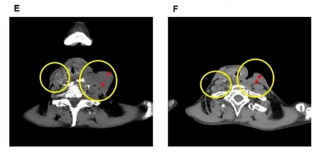 下咽頭がんの治療前後のCT画像(Yorozu et al., 2022, Fig.3より引用)